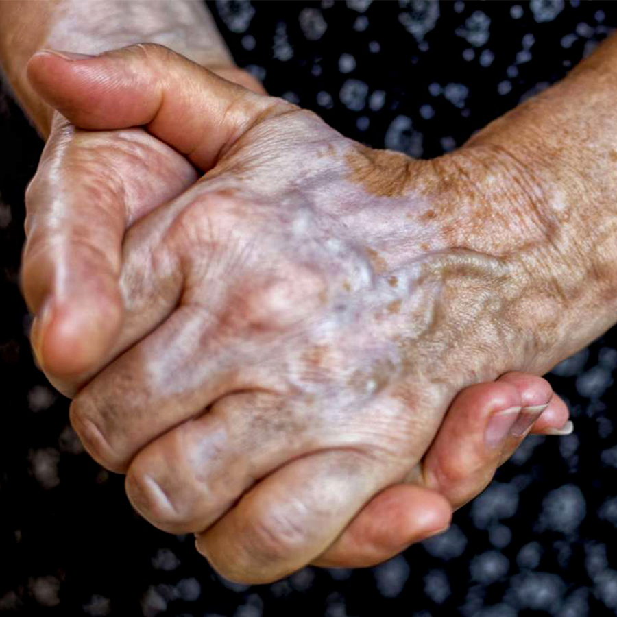 Tê bì tay chân - Nguyên nhân, triệu chứng và cách điều trị bằng đông y