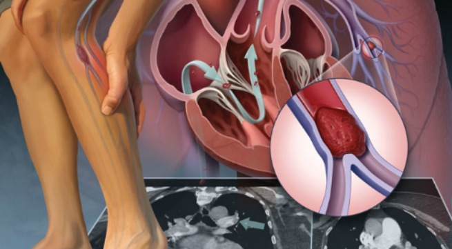 Các yếu tố thuận lợi của bệnh viêm tắc tĩnh mạch