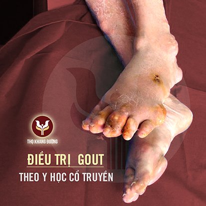 Điều trị gout theo y học cổ truyền