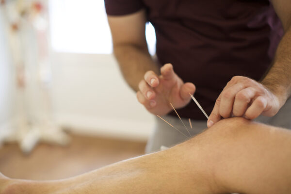 Điều trị hiệu quả suy giãn tĩnh mạch bằng châm cứu