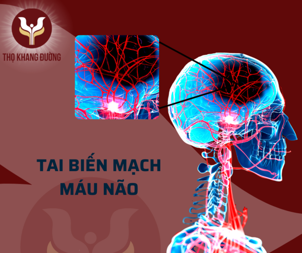 Tai biến mạch máu não - Nguyên nhân, triệu chứng và cách điều trị