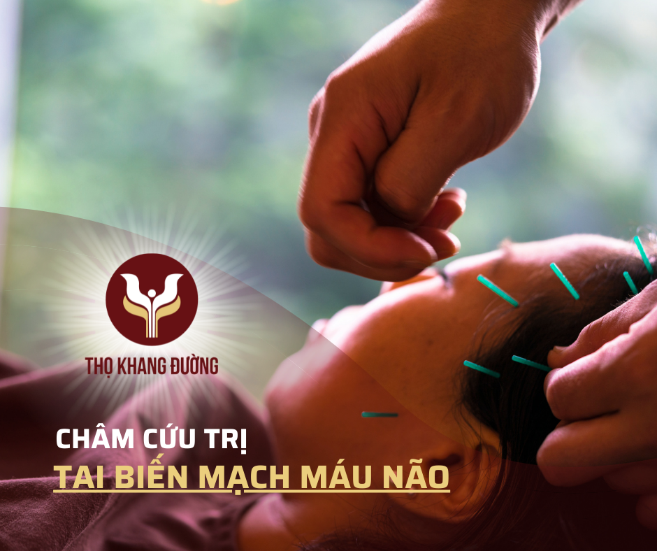 Châm cứu điều trị tai biến mạch máu não