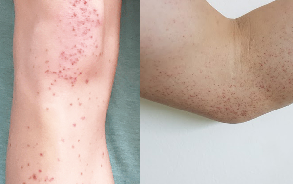 Tổng quan về bệnh viêm mao mạch dị ứng