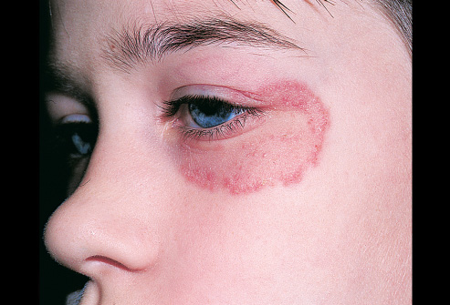 Hắc lào - bệnh ngoài da cần điều trị ngay, tránh lây nan